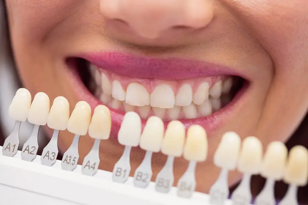 todo-lo-que-necesitas-saber-blanqueamiento-dental-2