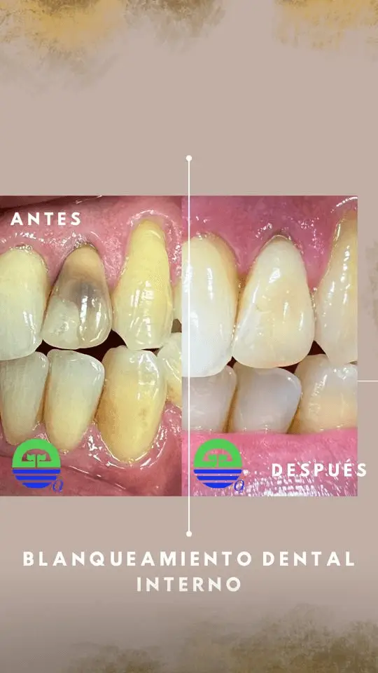 blanqueamineto-dental-interno