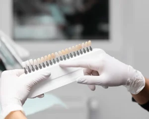cuando deberías considerar carillas dentales