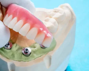 protesis dental implantosoportada Majadahonda