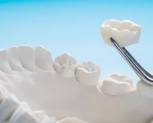 protesis-dentales-majadahonda-corona-dental