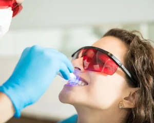 todo lo que necesitas saber blanqueamiento dental